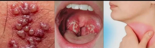 Gonorrea