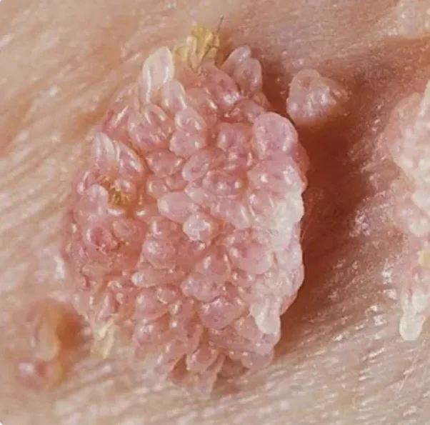 Papiloma Humano (VPH)